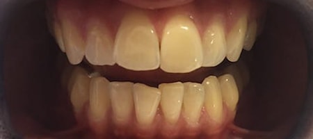 Before Invisalign Treatment Smile Rooms Glasgow