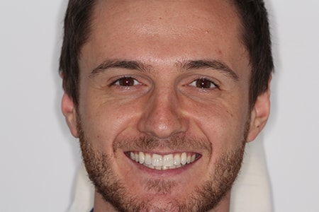 After Invisalign Treatment Smile Rooms Glasgow