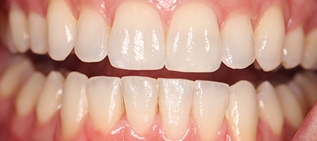 After Invisalign Treatment Smile Rooms Glasgow