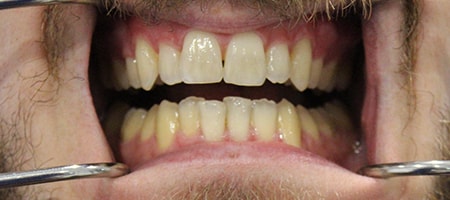 Before Invisalign Treatment Smile Rooms Glasgow