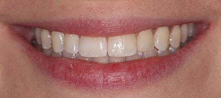 After Invisalign Treatment Smile Rooms Glasgow