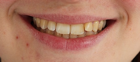 Before Invisalign Treatment Smile Rooms Glasgow