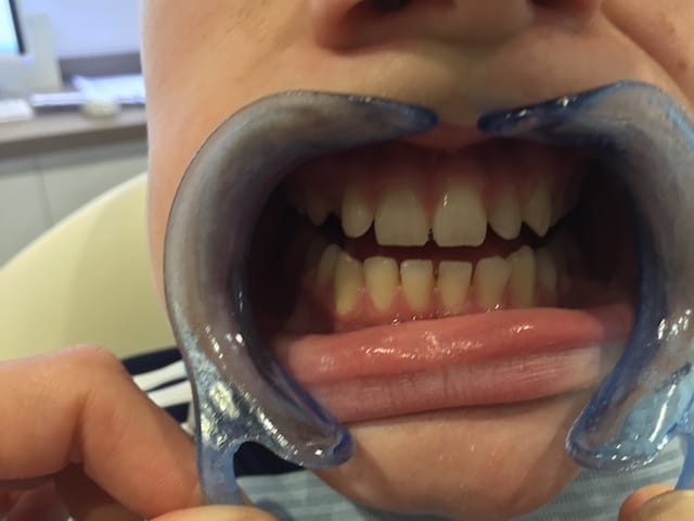 reading-smiles-invisalign-teenager-b3