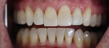 After Invisalign Treatment Smile Rooms Glasgow