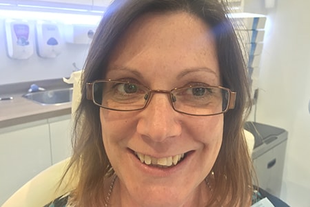 Before Invisalign Treatment Smile Rooms Glasgow