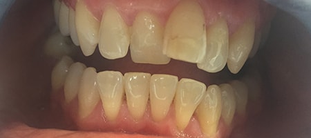 Before Invisalign Treatment Smile Rooms Glasgow