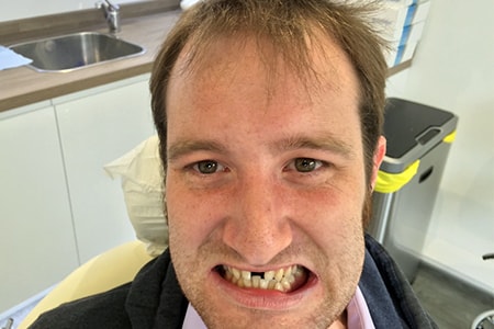 Before Invisalign Treatment Smile Rooms Glasgow