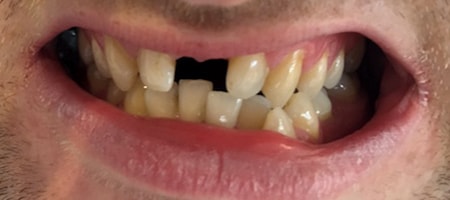Before Invisalign Treatment Smile Rooms Glasgow