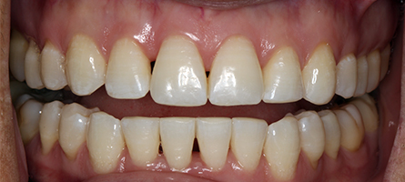 After Invisalign Treatment Smile Rooms Glasgow