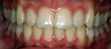 After Invisalign Treatment Smile Rooms Glasgow