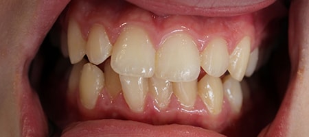 Before Invisalign Treatment Smile Rooms Glasgow