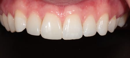 After Invisalign Treatment Reading Smiles 