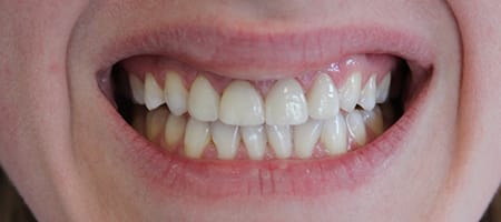 After Veneers Treatment Reading Smiles 
